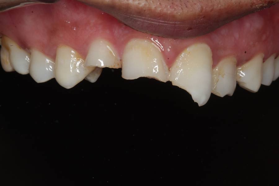 Before — Composite Veneers Tulip Dental Dombivli