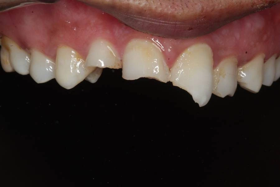 Before, Composite Veneers Tulip Dental Dombivli