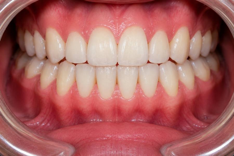 Braces result Dombivli