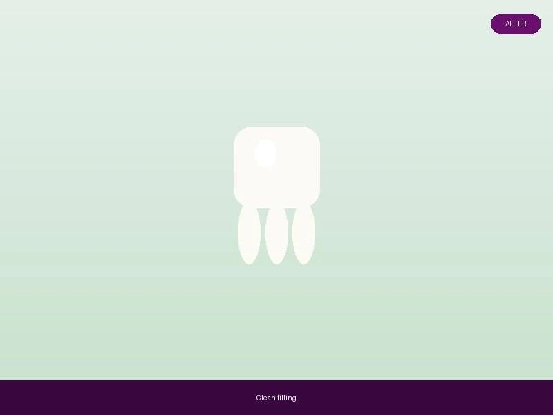 After, Tooth-Coloured Filling Tulip Dental Dombivli