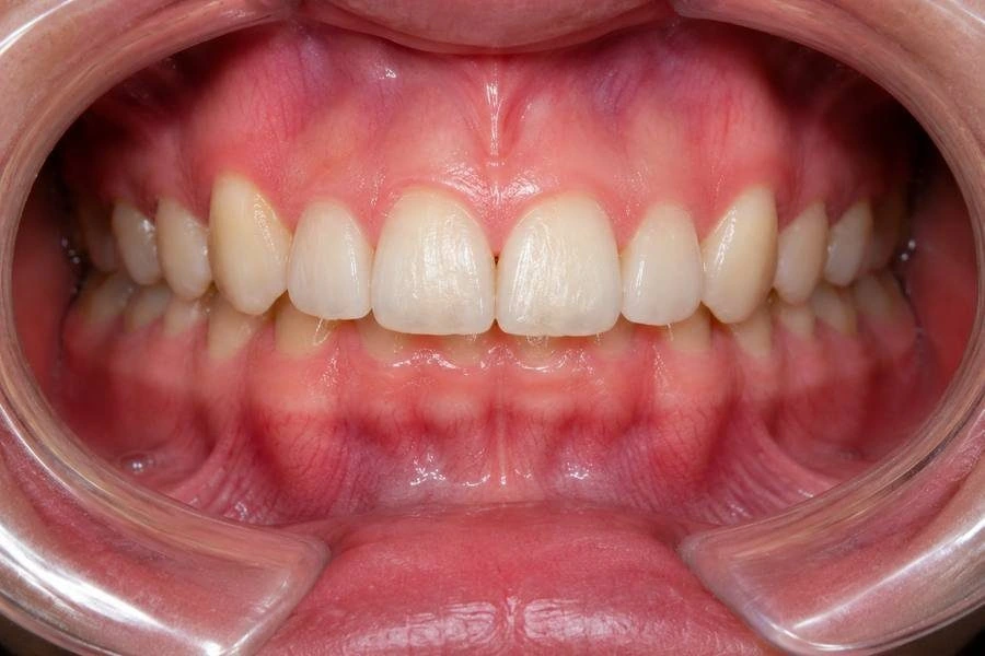 Before, Smile Transformation Tulip Dental Dombivli