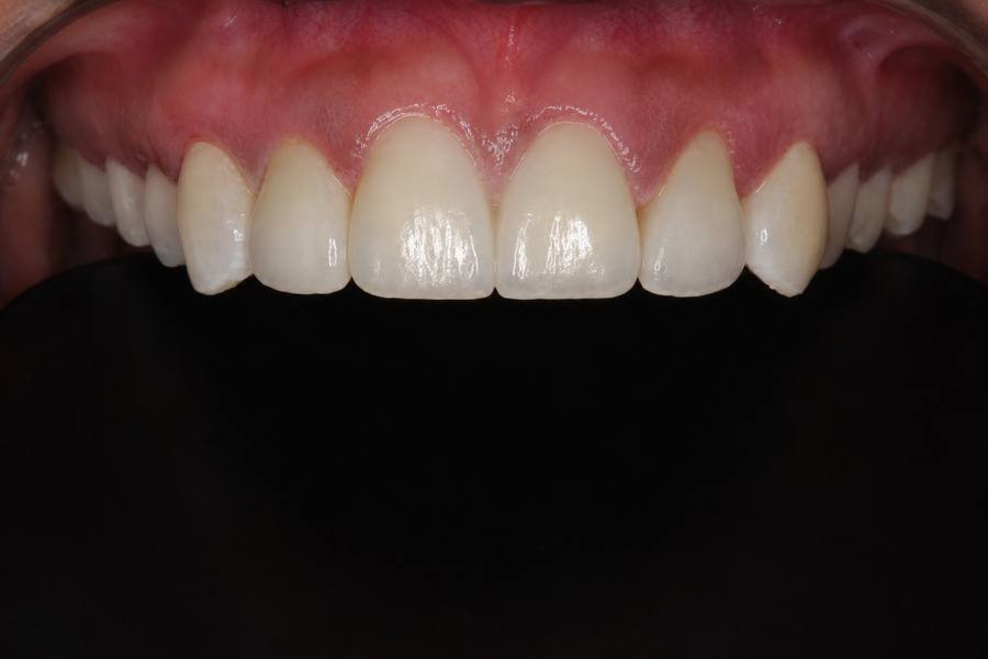 After — Ceramic Veneers Tulip Dental Dombivli