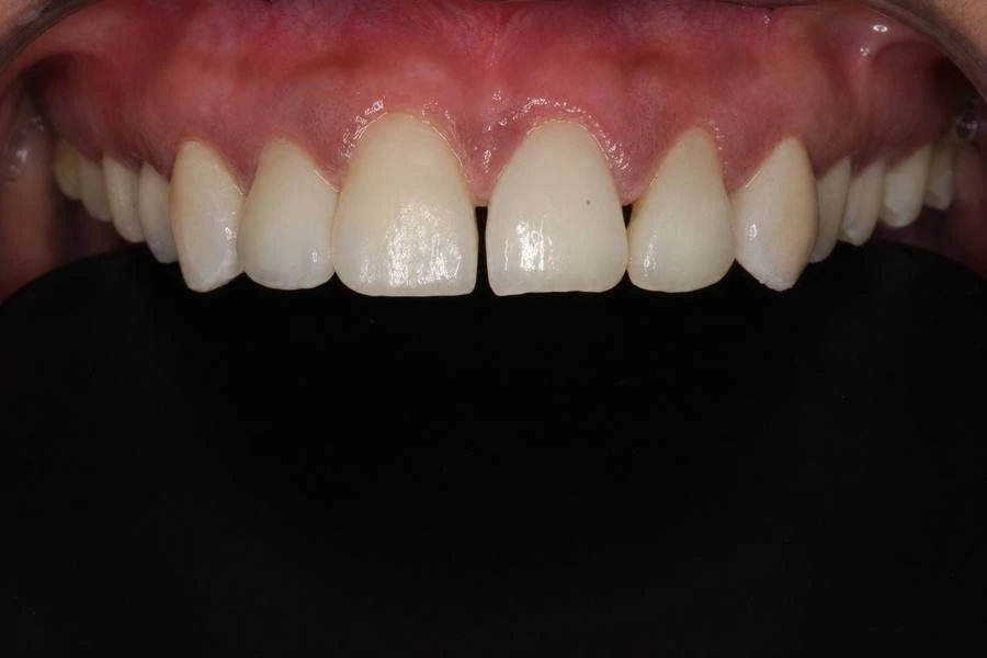Before, Ceramic Veneers Tulip Dental Dombivli