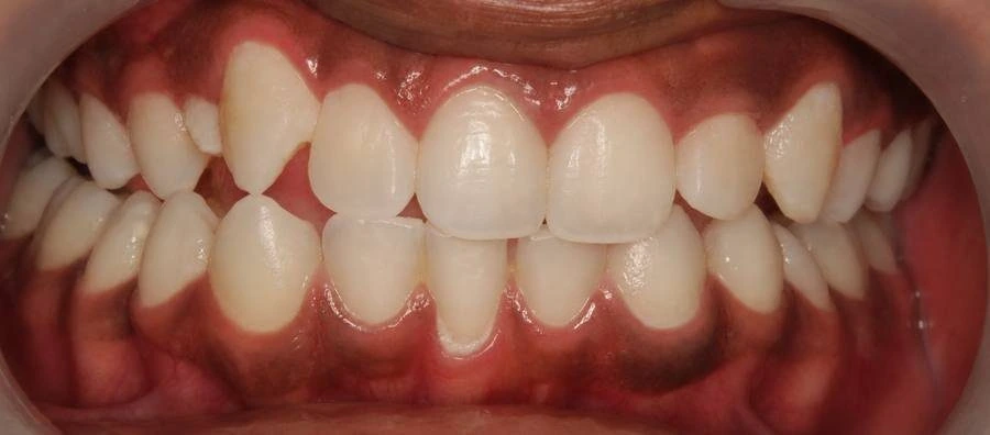 Teeth whitening result Dombivli