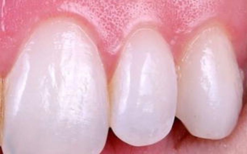 Gum Treatment Periodontist Dombivli