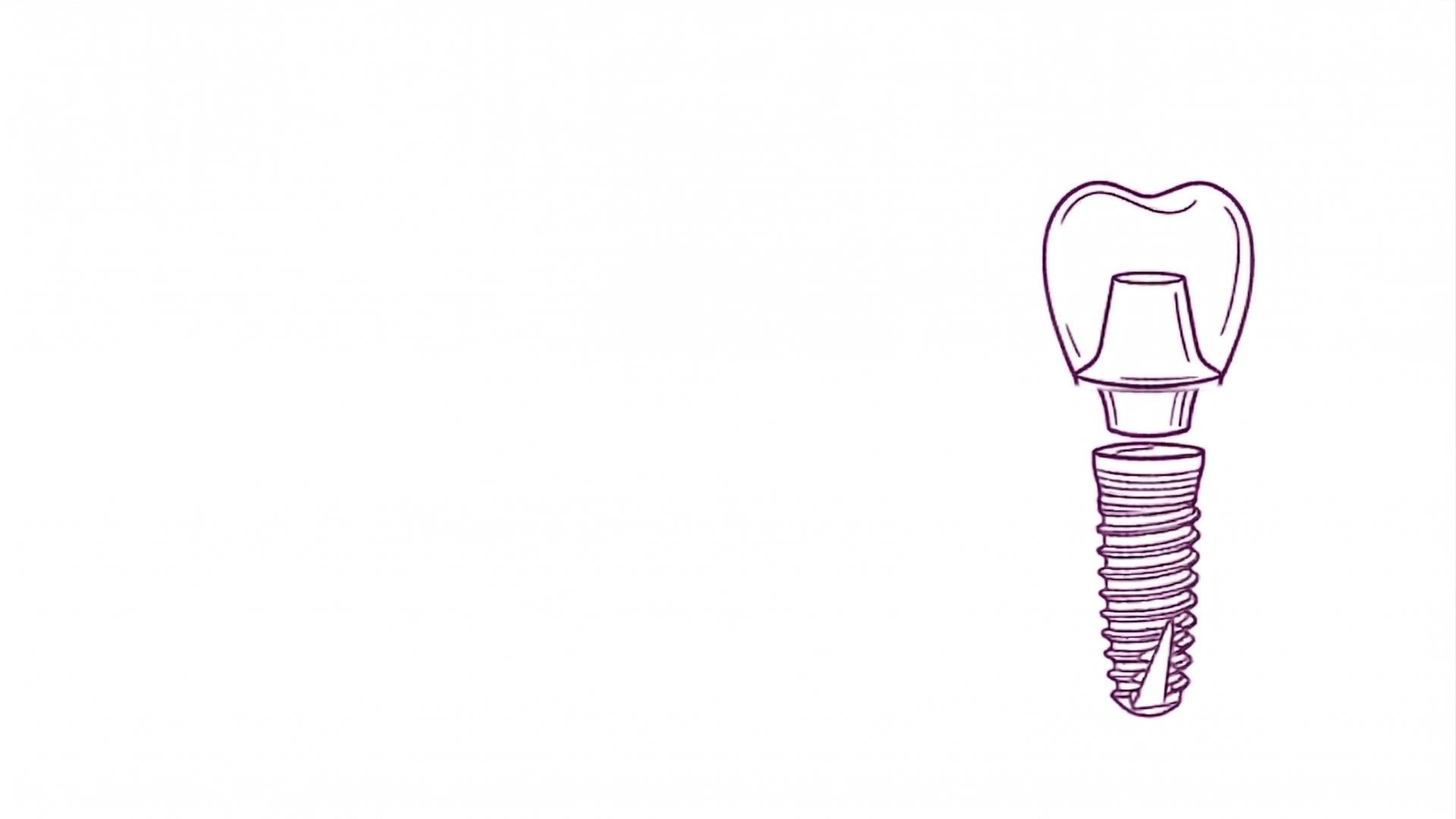 Dental implants Dombivli